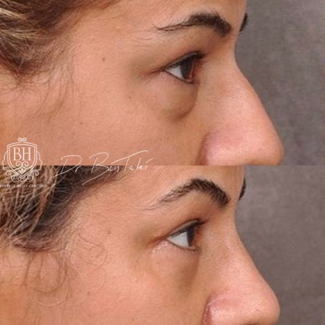 Beverly Hills Center Female Patient Before and After Rhinoplasty and Lower Eyelids