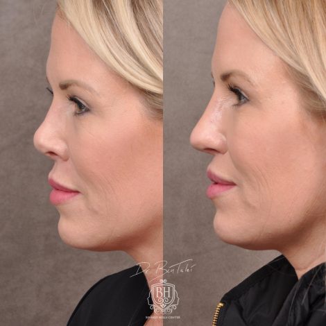 Beverly Hills Center Female Patient Before and After Revision Rhinoplasty and Lip Lift Procedure