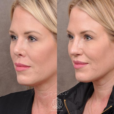 Beverly Hills Center Female Patient Before and After Revision Rhinoplasty and Lip Lift Procedure