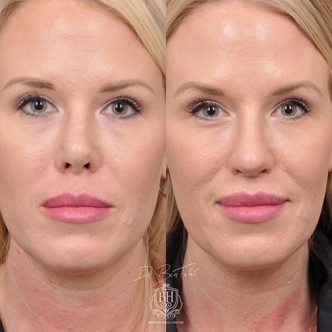Beverly Hills Center Female Patient Before and After Revision Rhinoplasty and Lip Lift Procedure