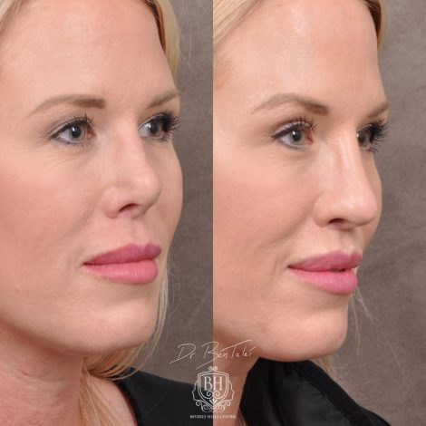 Beverly Hills Center Female Patient Before and After Revision Rhinoplasty and Lip Lift Procedure