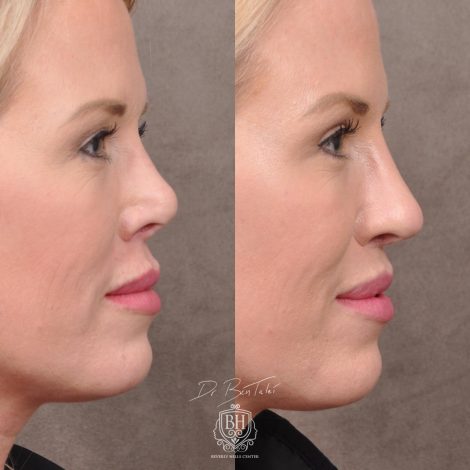 Beverly Hills Center Female Patient Before and After Revision Rhinoplasty and Lip Lift Procedure