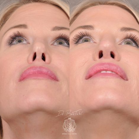 Beverly Hills Center Female Patient Before and After Revision Rhinoplasty and Lip Lift Procedure