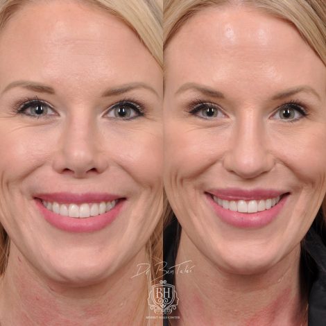 Beverly Hills Center Female Patient Before and After Revision Rhinoplasty and Lip Lift Procedure