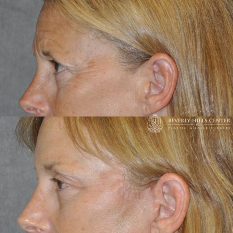 Beverly Hills Center Female Patient Before and After Facial Rejuvenation Procedures