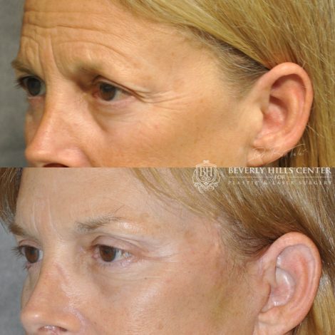 Beverly Hills Center Female Patient Before and After Facial Rejuvenation Procedures