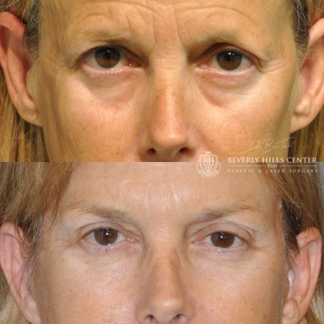Beverly Hills Center Female Patient Before and After Facial Rejuvenation Procedures