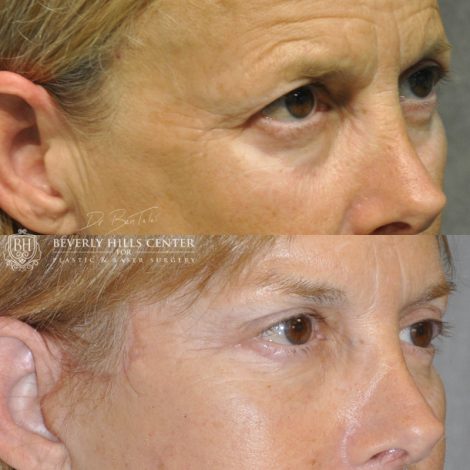 Beverly Hills Center Female Patient Before and After Facial Rejuvenation Procedures