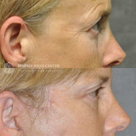 Beverly Hills Center Female Patient Before and After Facial Rejuvenation Procedures