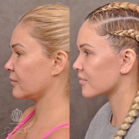 Beverly Hills Center Female Patient Before and After AuraLyft Porcedure