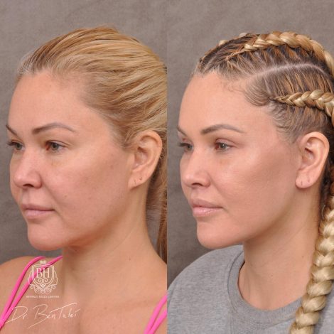 Beverly Hills Center Female Patient Before and After AuraLyft Porcedure
