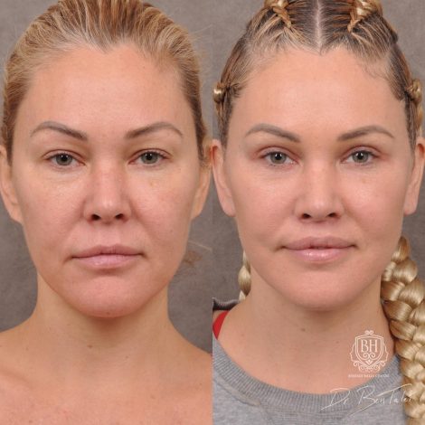 Beverly Hills Center Female Patient Before and After AuraLyft Porcedure