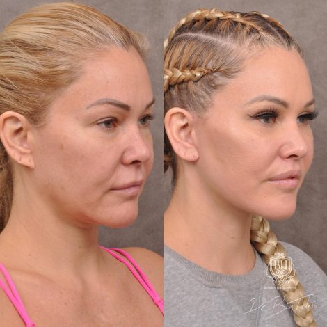 Beverly Hills Center Female Patient Before and After AuraLyft Porcedure