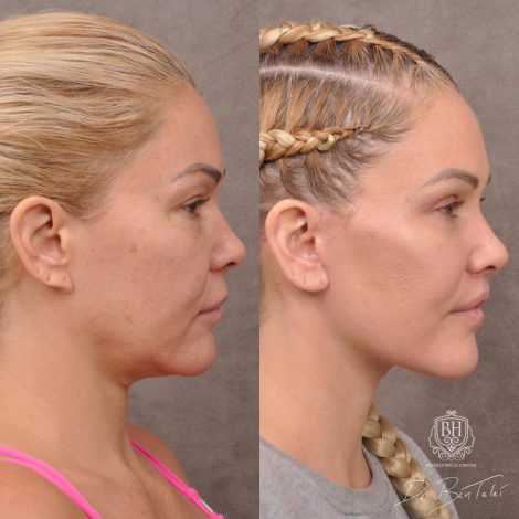 Beverly Hills Center Female Patient Before and After AuraLyft Porcedure