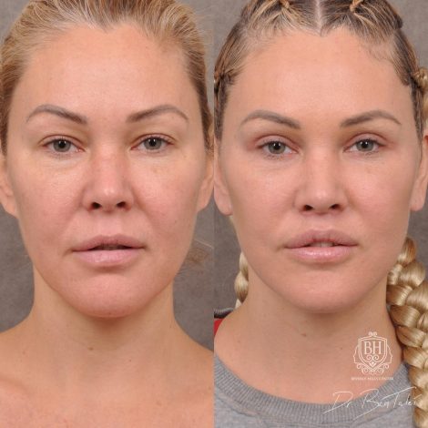 Beverly Hills Center Female Patient Before and After AuraLyft Porcedure