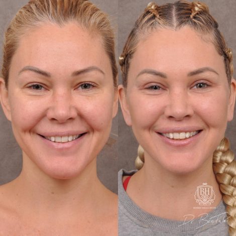 Beverly Hills Center Female Patient Before and After AuraLyft Porcedure