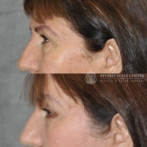 Beverly Hills Center Female Patient Before and After AuraLyft with Eyelid Rejuvenation Procedure