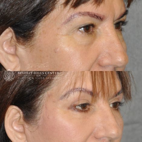 Beverly Hills Center Female Patient Before and After AuraLyft with Eyelid Rejuvenation Procedure