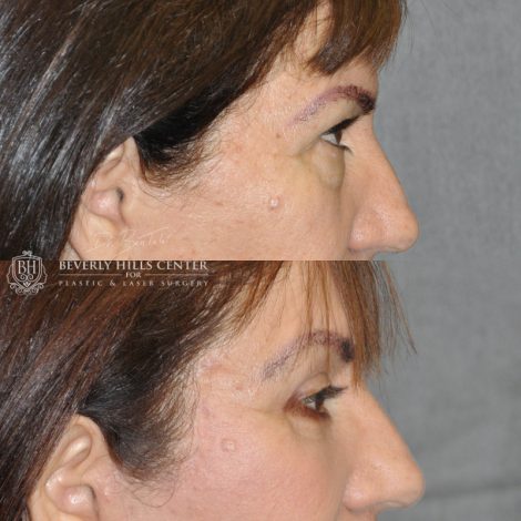 Beverly Hills Center Female Patient Before and After AuraLyft with Eyelid Rejuvenation Procedure