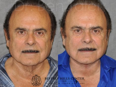Beverly Hills Center Male Patient Before and After Direct Neck Lift Procedure
