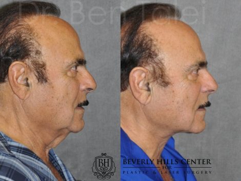 Beverly Hills Center Male Patient Before and After Direct Neck Lift Procedure