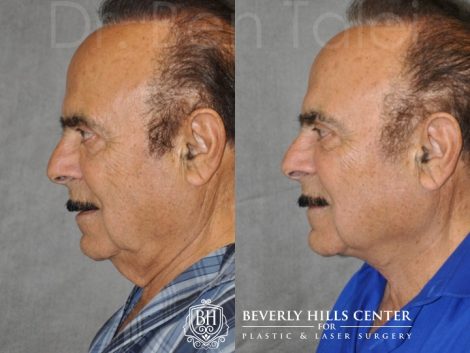 Beverly Hills Center Male Patient Before and After Direct Neck Lift Procedure