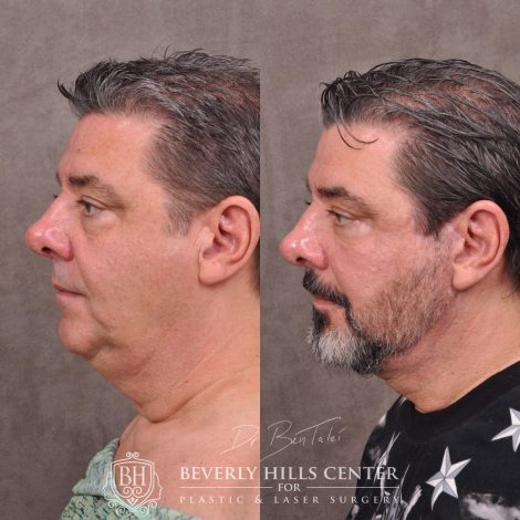 Beverly Hills Center Male Patient Before and After Auralyft for Men with Lower Eyelid Rejuvenation