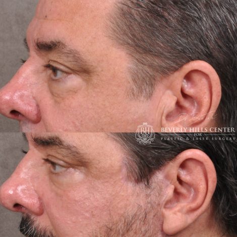 Beverly Hills Center Male Patient Before and After Facial Rejuvenation Procedures