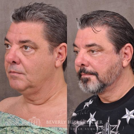 Beverly Hills Center Male Patient Before and After Auralyft for Men with Lower Eyelid Rejuvenation