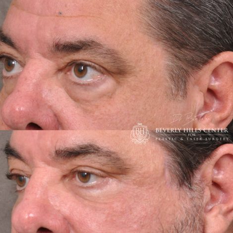 Beverly Hills Center Male Patient Before and After Facial Rejuvenation Procedures