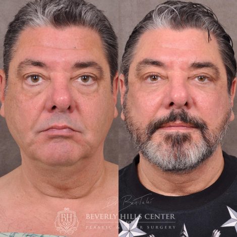 Beverly Hills Center Male Patient Before and After Auralyft for Men with Lower Eyelid Rejuvenation