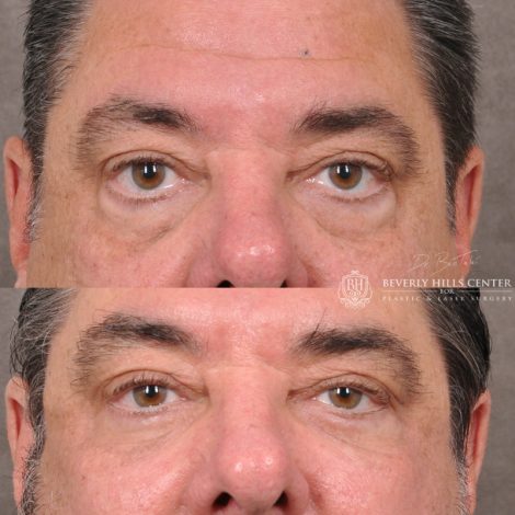 Beverly Hills Center Male Patient Before and After Facial Rejuvenation Procedures