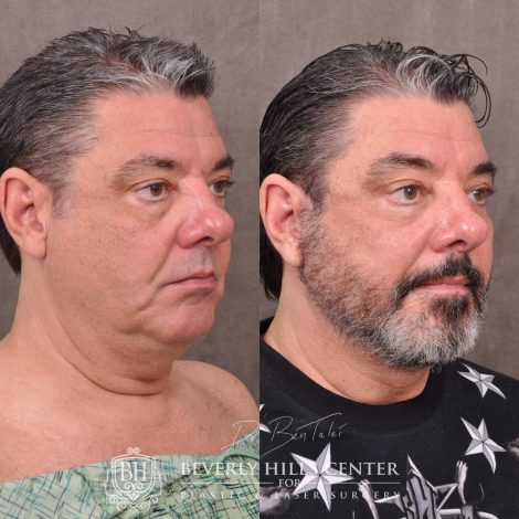 Beverly Hills Center Male Patient Before and After Auralyft for Men with Lower Eyelid Rejuvenation