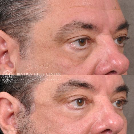 Beverly Hills Center Male Patient Before and After Facial Rejuvenation Procedures