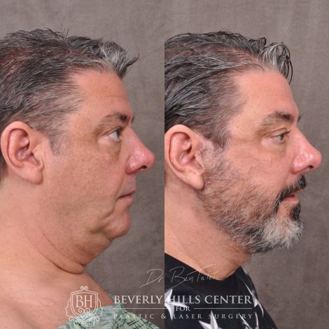 Beverly Hills Center Male Patient Before and After Auralyft for Men with Lower Eyelid Rejuvenation