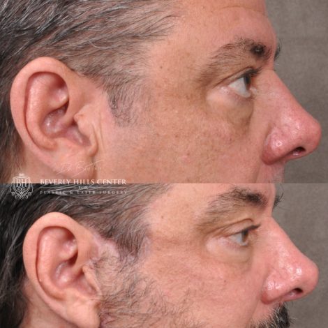 Beverly Hills Center Male Patient Before and After Facial Rejuvenation Procedures