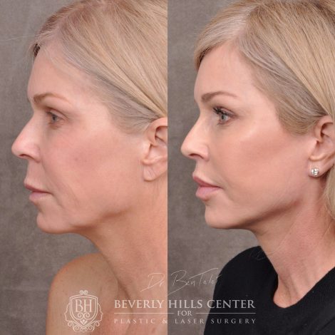 Beverly Hills Center Female Patient Before and After Auralyft, Mini Brow Lift, Lip Lift, Upper Eyelid Tightening