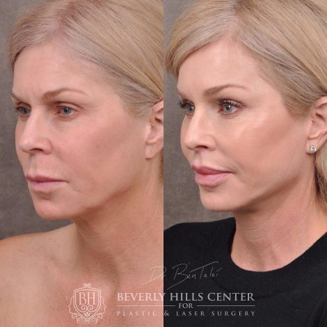 Beverly Hills Center Female Patient Before and After Auralyft, Mini Brow Lift, Lip Lift, Upper Eyelid Tightening
