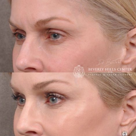 Beverly Hills Center Female Patient Before and After Auralyft, Mini Brow Lift Revision, Lip Lift, Upper Eyelid Tightening Procedures