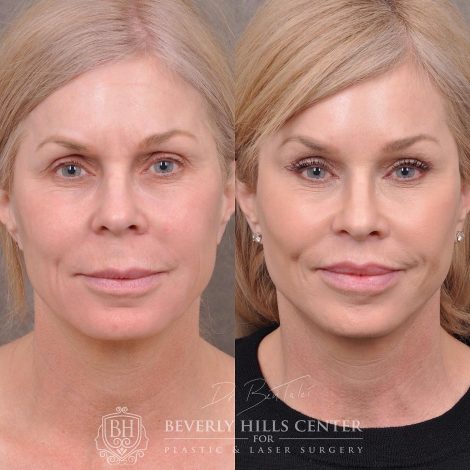 Beverly Hills Center Female Patient Before and After Auralyft, Mini Brow Lift, Lip Lift, Upper Eyelid Tightening