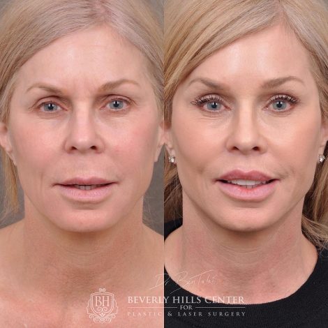Beverly Hills Center Female Patient Before and After Auralyft, Mini Brow Lift, Lip Lift, Upper Eyelid Tightening