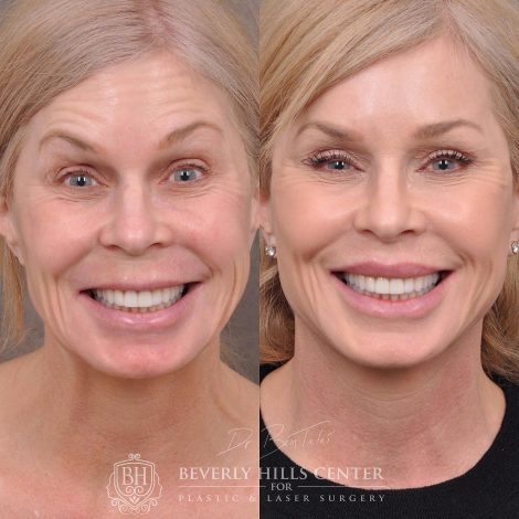 Beverly Hills Center Female Patient Before and After Auralyft, Mini Brow Lift, Lip Lift, Upper Eyelid Tightening
