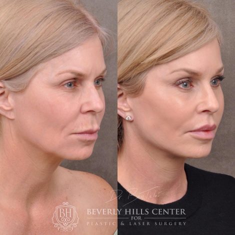 Beverly Hills Center Female Patient Before and After Auralyft, Mini Brow Lift, Lip Lift, Upper Eyelid Tightening