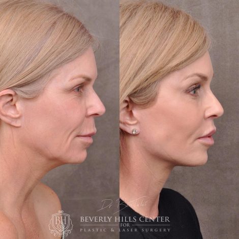Beverly Hills Center Female Patient Before and After Auralyft, Mini Brow Lift, Lip Lift, Upper Eyelid Tightening
