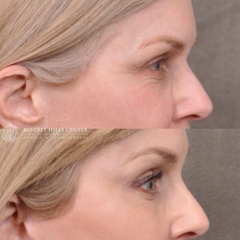 Beverly Hills Center Female Patient Before and After Auralyft, Mini Brow Lift Revision, Lip Lift, Upper Eyelid Tightening Procedures