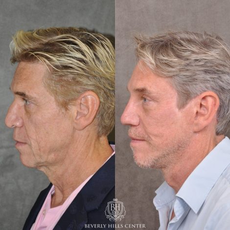 Beverly Hills Center Male Patient Before and After Auralyft, Mini Brow Lift, Upper Bleph, Revision Rhinoplasty, Modified Upper Lip Lift