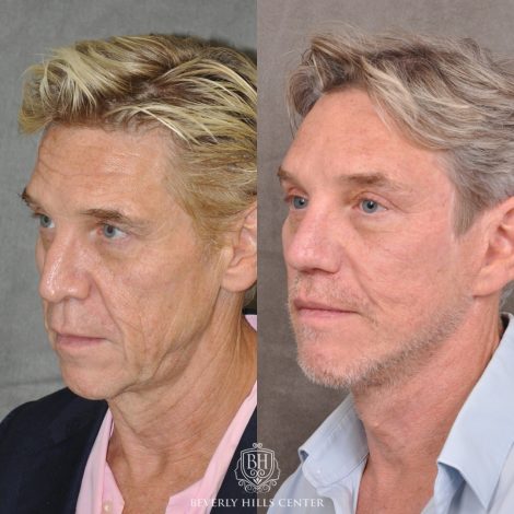 Beverly Hills Center Male Patient Before and After Auralyft, Mini Brow Lift, Upper Bleph, Revision Rhinoplasty, Modified Upper Lip Lift