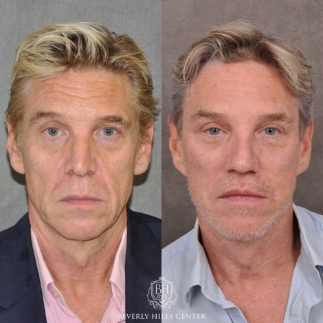 Beverly Hills Center Male Patient Before and After Auralyft, Mini Brow Lift, Upper Bleph, Revision Rhinoplasty, Modified Upper Lip Lift