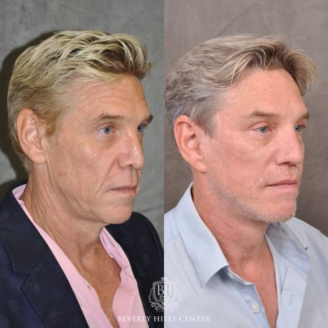 Beverly Hills Center Male Patient Before and After Auralyft, Mini Brow Lift, Upper Bleph, Revision Rhinoplasty, Modified Upper Lip Lift