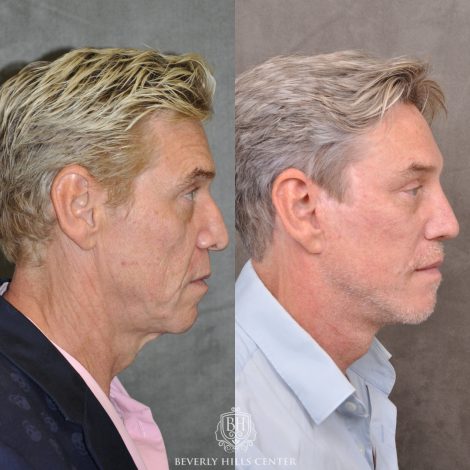 Beverly Hills Center Male Patient Before and After Auralyft, Mini Brow Lift, Upper Bleph, Revision Rhinoplasty, Modified Upper Lip Lift